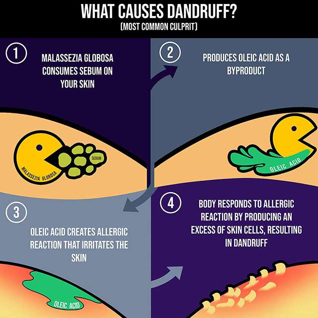 The Cause Of Dandruff