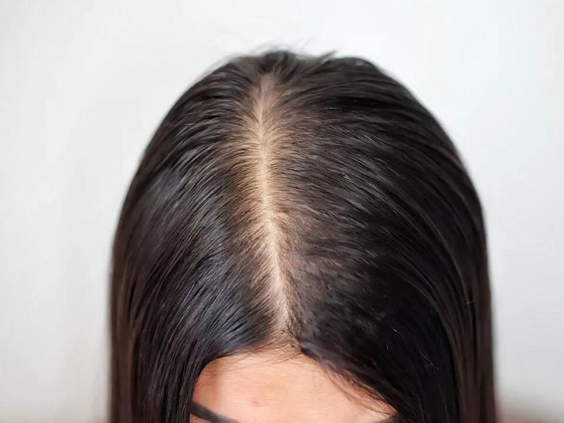 Thin hair is a big deal for most of those who get stuck in 