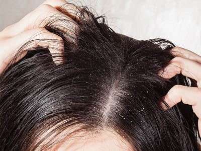 Dandruff a reason of itchy scalp and hair loss